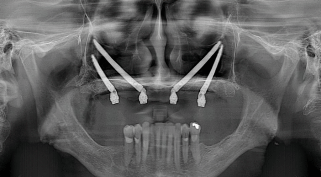 zygoma implants panoramic xray