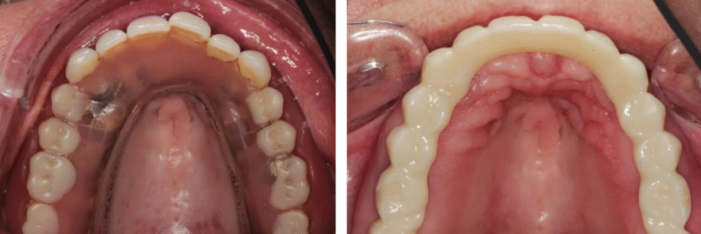 klikprothese vs. vaste brug