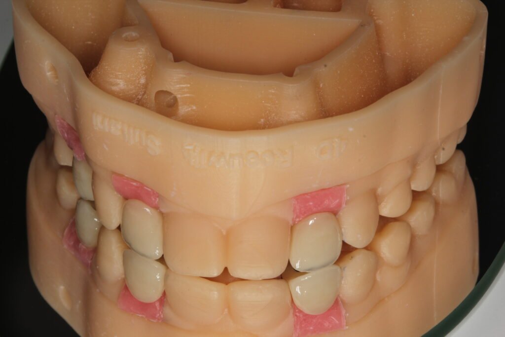 Dental implant on a model