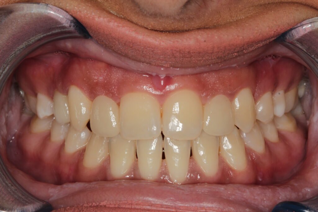 dental implant front