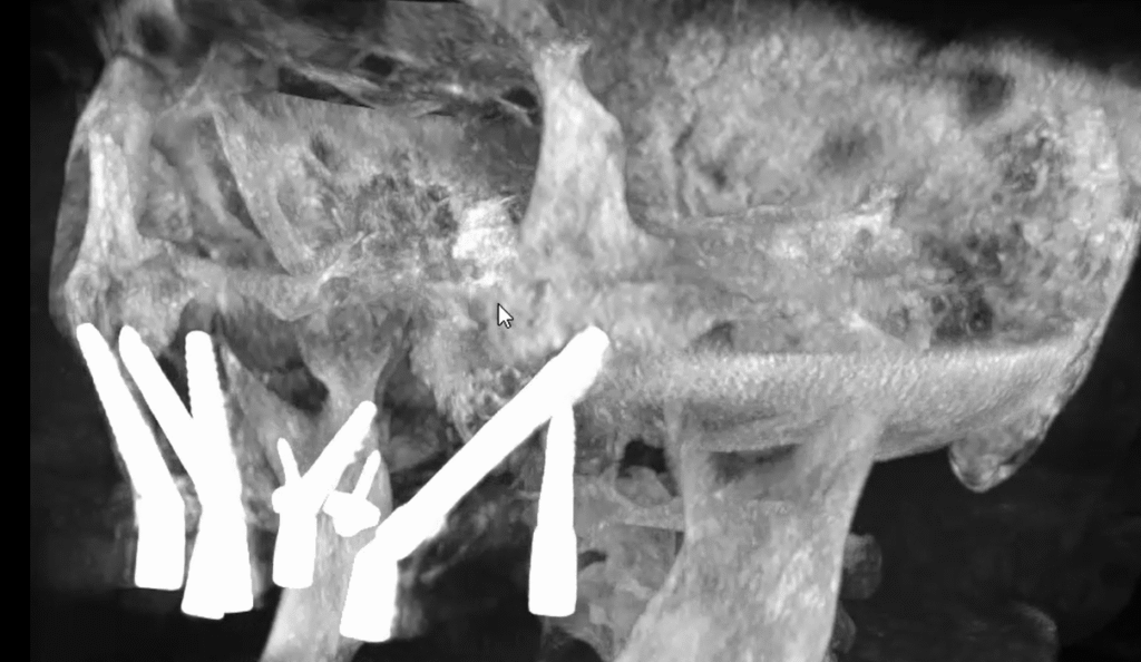 Hybrid zygoma tran-nasal ptyrigoid
