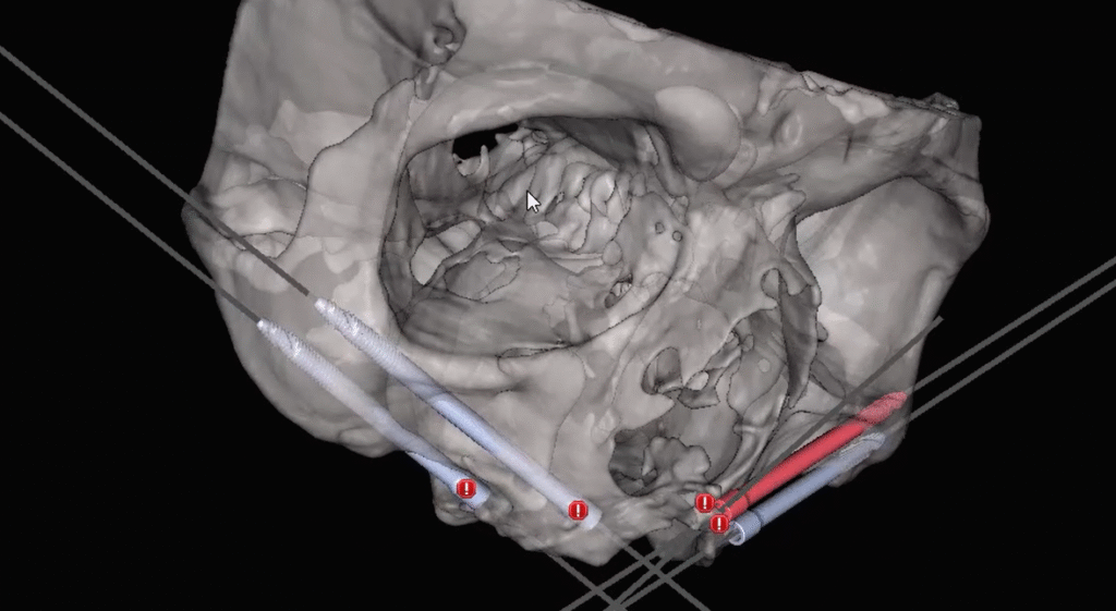 Quad zygoma 3D planning BSP