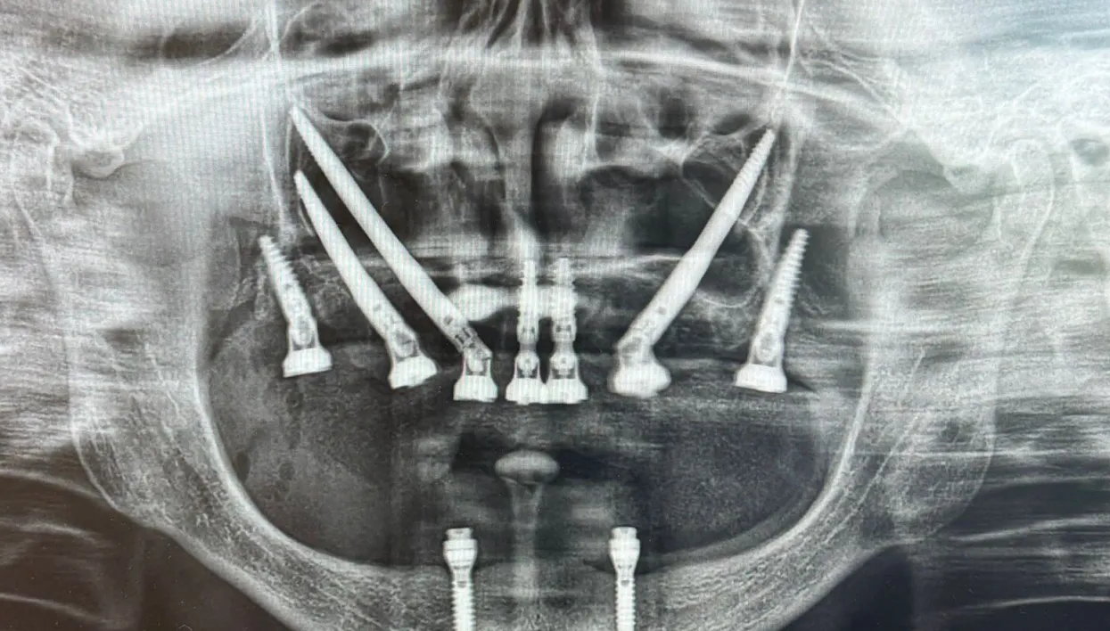 Zygoma panoramic xray
