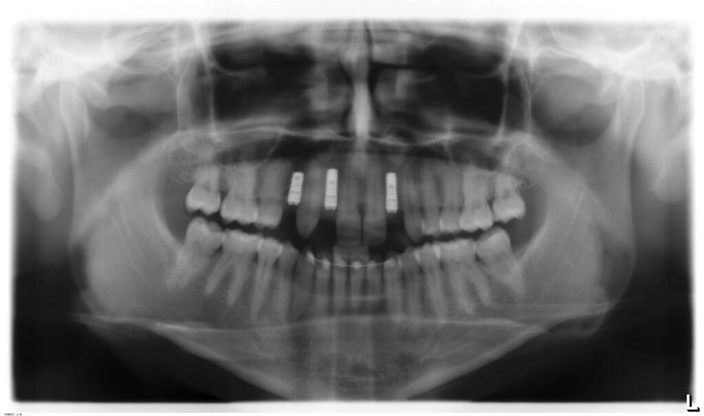 panorama xray showing implants